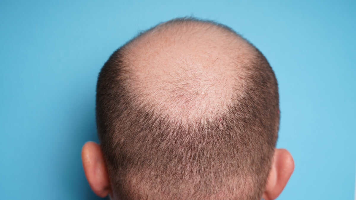 大麻成分が脱毛症に悩む人々の発毛を促進　既存薬を上回る効果